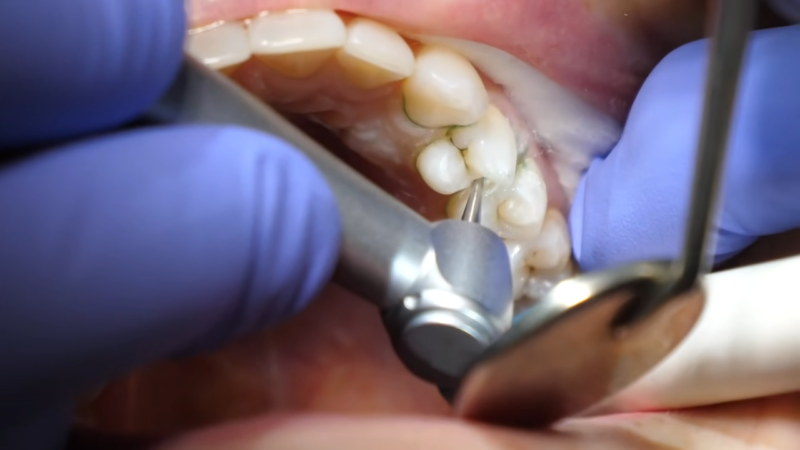 Prikaz stomatološkog tretmana uklanjanja karijesa sa zuba pomoću dentalne bušilice